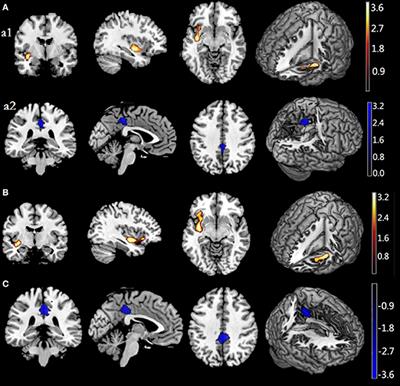 Regional Gray Matter Volume Is Associated with Restrained Eating in Healthy Chinese Young Adults: Evidence from Voxel-Based Morphometry